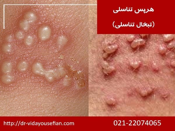  انتقال تبخال تناسلی از طریق لباس + درمان تبخال تناسلی + ویروس هرپس