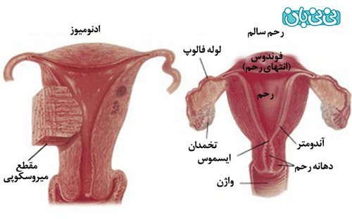  چه چیزی باعث شقاق مقعدی می‌شود + پماد برای ترک واژن-شقاق واژن