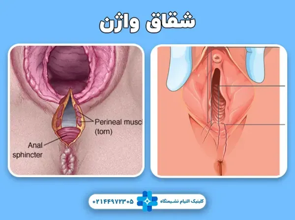  چه چیزی باعث شقاق مقعدی می‌شود + پماد برای ترک واژن-شقاق واژن