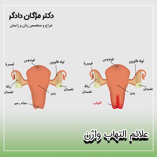  آیا در مذی اسپرم وجود دارد + چرا بعد از رابطه جنسی واژن ورم می‌کند