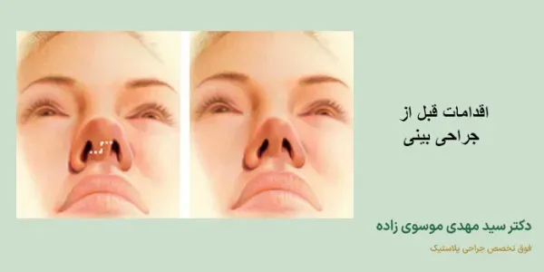  بعد از تزریق ژل صورت چی بخورم + سردرد بعد از عمل بینی تا کی ادامه دارد