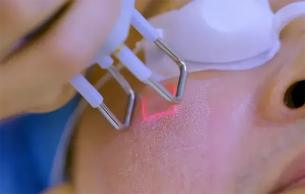  آیا بوتاکس سرطان‌زاست + آیا لیزر ژل لب را از بین می‌برد