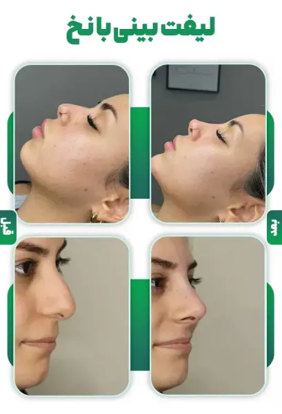  آیا بوتاکس سرطان‌زاست + آیا لیزر ژل لب را از بین می‌برد