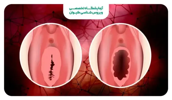 علائم پاره شدن بکارت+پارگی پرده بکارت با انگشت+ از کجا بفهمیم زگیل تناسلی داریم