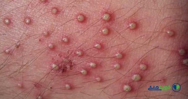  علائم پاره شدن بکارت+پارگی پرده بکارت با انگشت+ از کجا بفهمیم زگیل تناسلی داریم