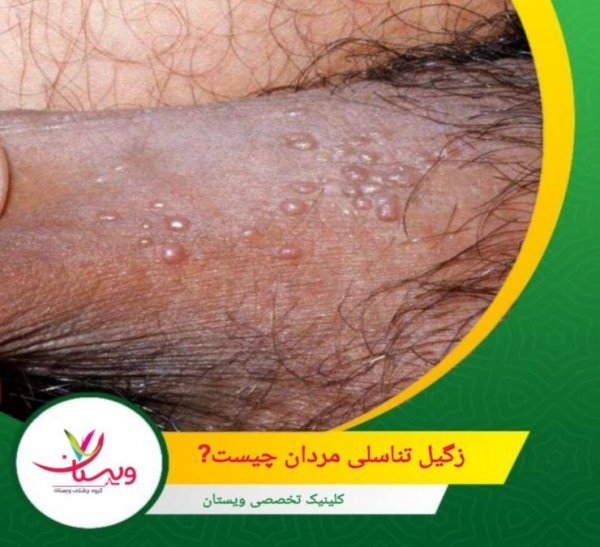  علائم پاره شدن بکارت+پارگی پرده بکارت با انگشت+ از کجا بفهمیم زگیل تناسلی داریم
