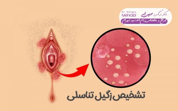  علائم پاره شدن بکارت+پارگی پرده بکارت با انگشت+ از کجا بفهمیم زگیل تناسلی داریم