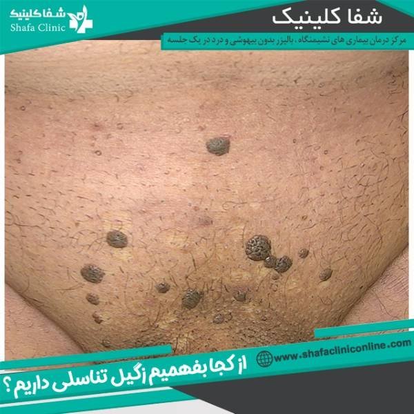  علائم پاره شدن بکارت+پارگی پرده بکارت با انگشت+ از کجا بفهمیم زگیل تناسلی داریم