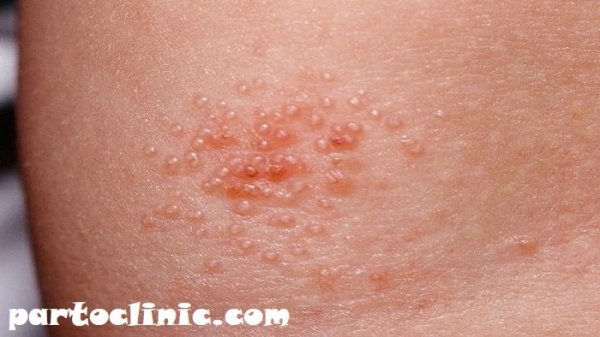  علائم پاره شدن بکارت+پارگی پرده بکارت با انگشت+ از کجا بفهمیم زگیل تناسلی داریم