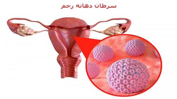  علائم پاره شدن بکارت+پارگی پرده بکارت با انگشت+ از کجا بفهمیم زگیل تناسلی داریم