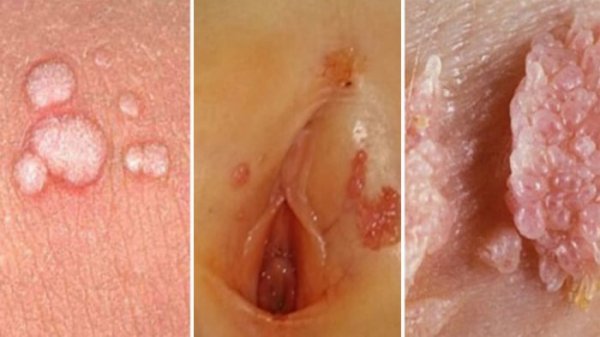  علائم پاره شدن بکارت+پارگی پرده بکارت با انگشت+ از کجا بفهمیم زگیل تناسلی داریم