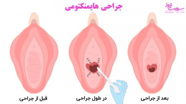  علائم پاره شدن بکارت+پارگی پرده بکارت با انگشت+ از کجا بفهمیم زگیل تناسلی داریم