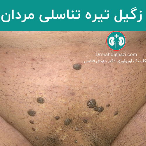 زگیل تناسلی مردان + علائم زگیل تناسلی مردان + بهترین پماد برای زگیل تناسلی مردان