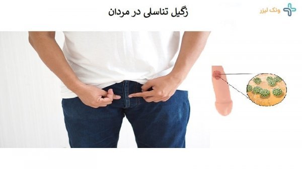  زگیل تناسلی مردان + علائم زگیل تناسلی مردان + بهترین پماد برای زگیل تناسلی مردان