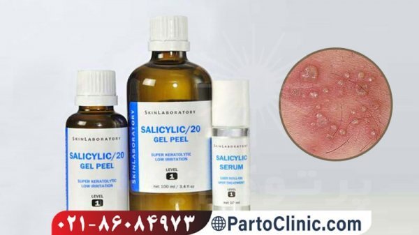  زگیل تناسلی مردان + علائم زگیل تناسلی مردان + بهترین پماد برای زگیل تناسلی مردان