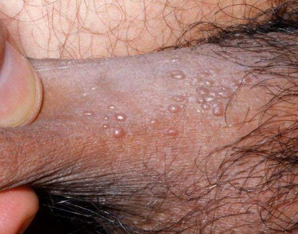  زگیل تناسلی مردان + علائم زگیل تناسلی مردان + بهترین پماد برای زگیل تناسلی مردان