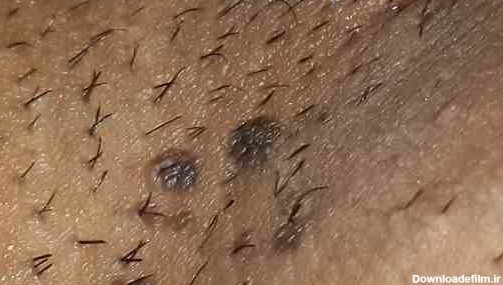  زگیل تناسلی مردان + علائم زگیل تناسلی مردان + بهترین پماد برای زگیل تناسلی مردان