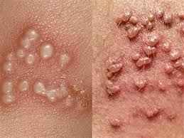  زگیل تناسلی مردان + علائم زگیل تناسلی مردان + بهترین پماد برای زگیل تناسلی مردان