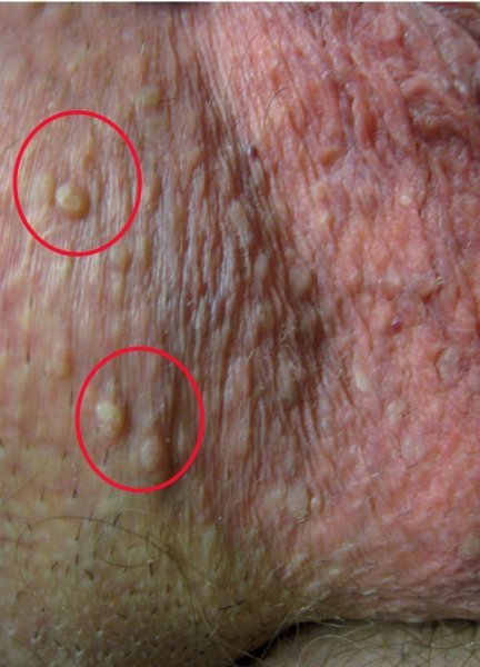  زگیل تناسلی مردان + علائم زگیل تناسلی مردان + بهترین پماد برای زگیل تناسلی مردان