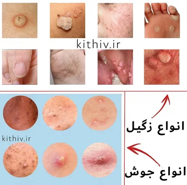  از کجا بفهمیم زگیل تناسلی داریم یا جوش + رفع زود انزالی فوری + پرده بکارت