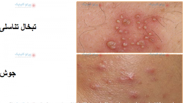  از کجا بفهمیم زگیل تناسلی داریم یا جوش + رفع زود انزالی فوری + پرده بکارت