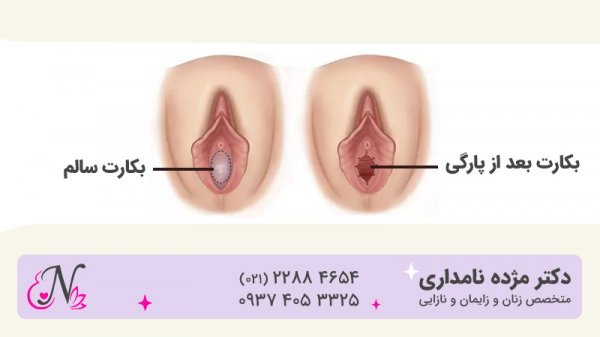 پرده بکارت سالم + عکس رحم سالم دختر + آیا مالش واژن باعث حاملگی می‌شود