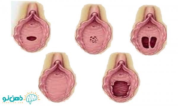  پرده بکارت سالم + عکس رحم سالم دختر + آیا مالش واژن باعث حاملگی می‌شود