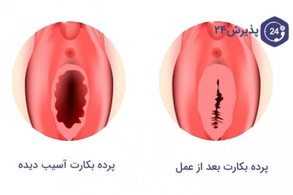  پرده بکارت سالم + عکس رحم سالم دختر + آیا مالش واژن باعث حاملگی می‌شود