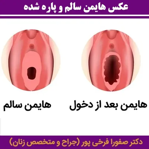  پرده بکارت سالم + عکس رحم سالم دختر + آیا مالش واژن باعث حاملگی می‌شود