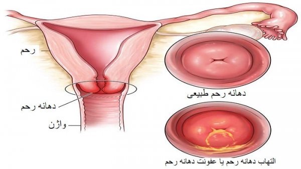  پرده بکارت سالم + عکس رحم سالم دختر + آیا مالش واژن باعث حاملگی می‌شود