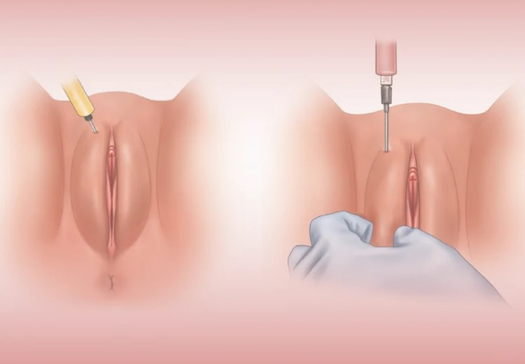  بهترین معجون لاغری شکم و پهلو + نحوه تزریق ژل و چربی به بیکینی