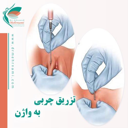  بهترین معجون لاغری شکم و پهلو + نحوه تزریق ژل و چربی به بیکینی