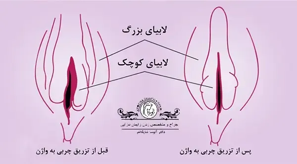  بهترین معجون لاغری شکم و پهلو + نحوه تزریق ژل و چربی به بیکینی