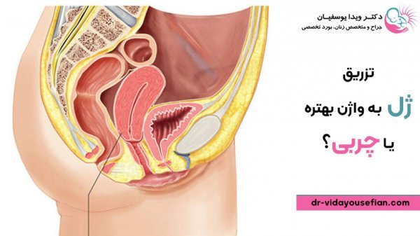  بهترین معجون لاغری شکم و پهلو + نحوه تزریق ژل و چربی به بیکینی