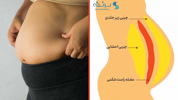  بهترین معجون لاغری شکم و پهلو + نحوه تزریق ژل و چربی به بیکینی