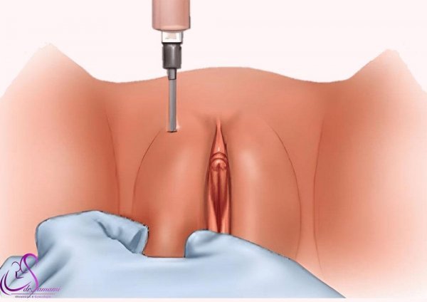  مراقبت های بعد از تزریق ژل به بیکینی+هزینه تزریق ژل به بیکینی+تنگ کننده بیکینی