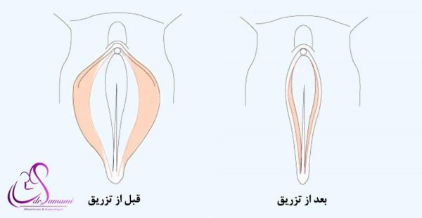  مراقبت های بعد از تزریق ژل به بیکینی+هزینه تزریق ژل به بیکینی+تنگ کننده بیکینی