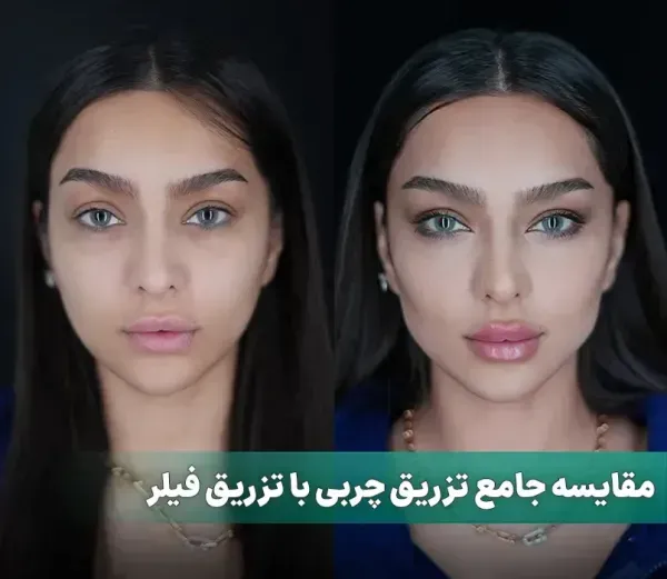 ماندگاری فیلر بیشتره یا چربی + ماندگاری فیلر بادی + تزریق چربی به هیپ دیپ