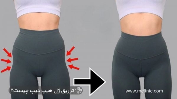  ماندگاری فیلر بیشتره یا چربی + ماندگاری فیلر بادی + تزریق چربی به هیپ دیپ