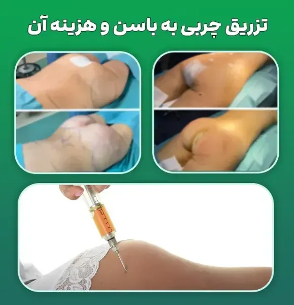  ماندگاری فیلر بیشتره یا چربی + ماندگاری فیلر بادی + تزریق چربی به هیپ دیپ