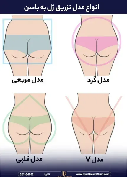  ماندگاری فیلر بیشتره یا چربی + ماندگاری فیلر بادی + تزریق چربی به هیپ دیپ