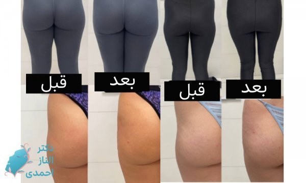  ماندگاری فیلر بیشتره یا چربی + ماندگاری فیلر بادی + تزریق چربی به هیپ دیپ