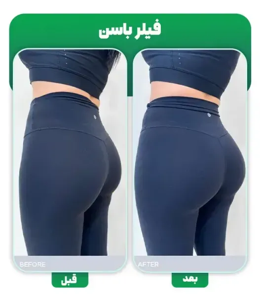  ماندگاری فیلر بیشتره یا چربی + ماندگاری فیلر بادی + تزریق چربی به هیپ دیپ