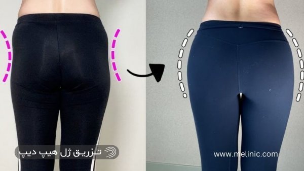  ماندگاری فیلر بیشتره یا چربی + ماندگاری فیلر بادی + تزریق چربی به هیپ دیپ