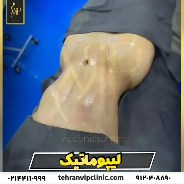 فیلم عمل جراحی شکم برای لاغری+فیلم و عکس پیکر تراشی بدون سانسور