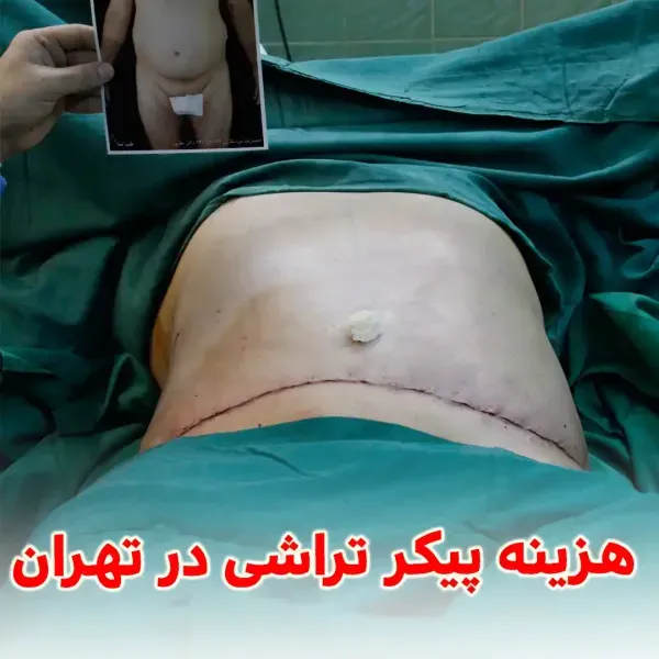  فیلم عمل جراحی شکم برای لاغری+فیلم و عکس پیکر تراشی بدون سانسور