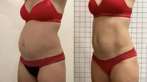  فیلم عمل جراحی شکم برای لاغری+فیلم و عکس پیکر تراشی بدون سانسور