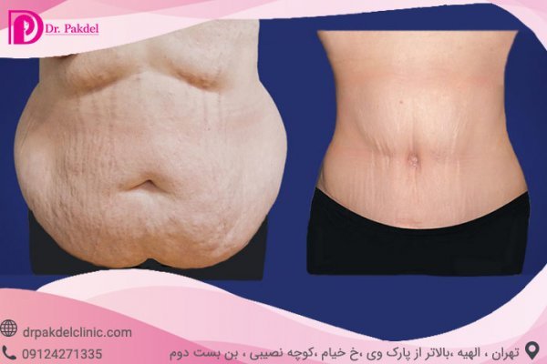  فیلم عمل جراحی شکم برای لاغری+فیلم و عکس پیکر تراشی بدون سانسور