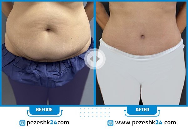  فیلم عمل جراحی شکم برای لاغری+فیلم و عکس پیکر تراشی بدون سانسور