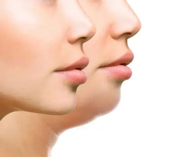  عکس قبل و بعد لاغری صورت+عکس تزریق چربی به صورت بعد از یک ماه